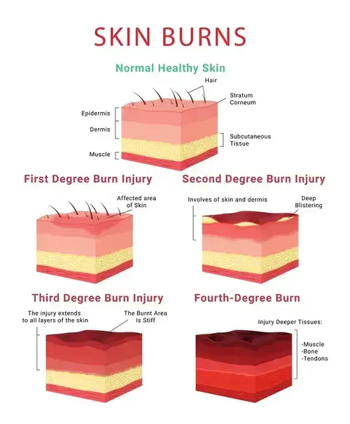 Injuries: Burn Injury Levels