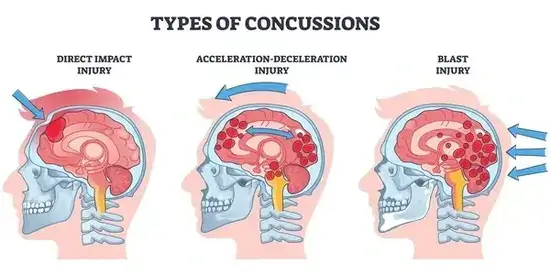 Injuries: Types of Concussions