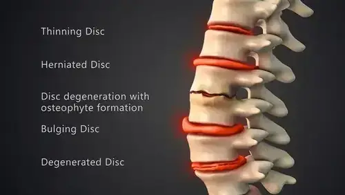 Injuries: Disc Injury Types